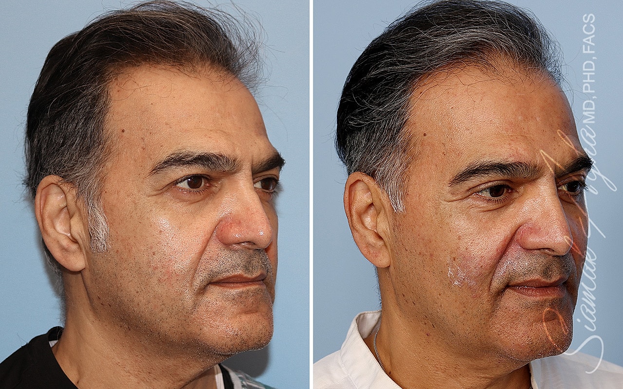 Blepharoplasty Before & After