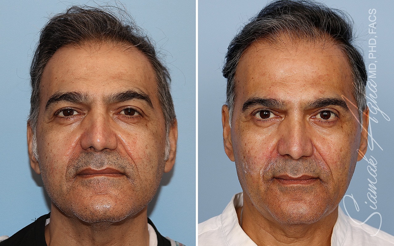 Blepharoplasty Before & After