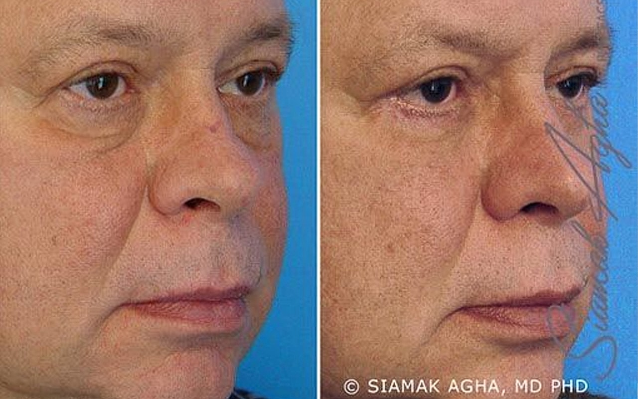 Blepharoplasty Before & After