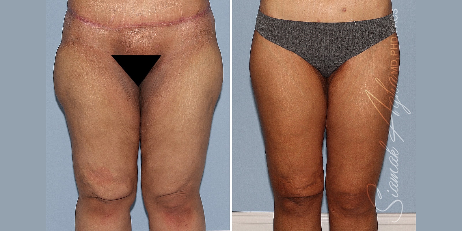 Before and after body transformation photos.