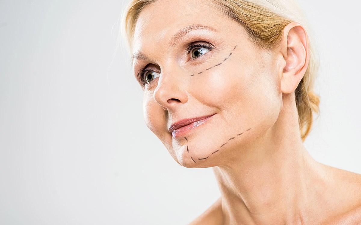 Woman with facial markings for cosmetic procedure
