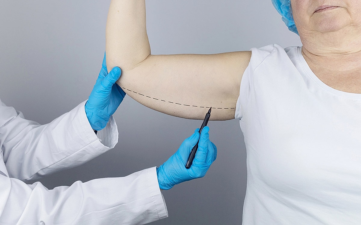 Doctor marking arm for cosmetic procedure preparation.