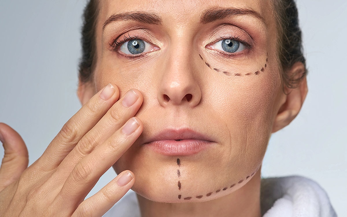 Woman with marked skin for cosmetic procedure.