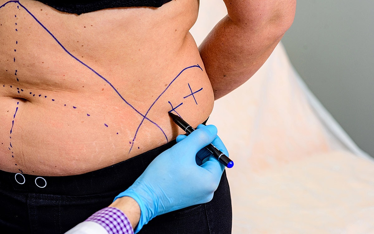 Body marking for a surgical procedure.