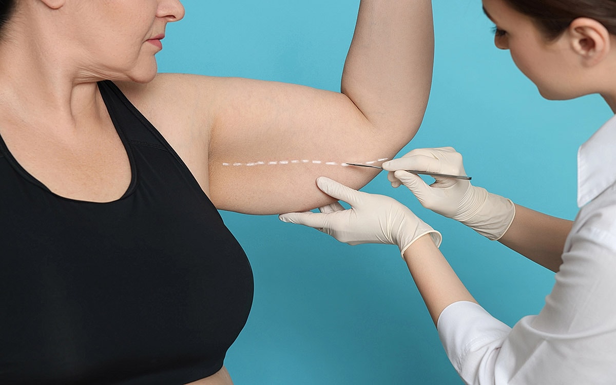 Consultation for arm liposuction procedure in progress.