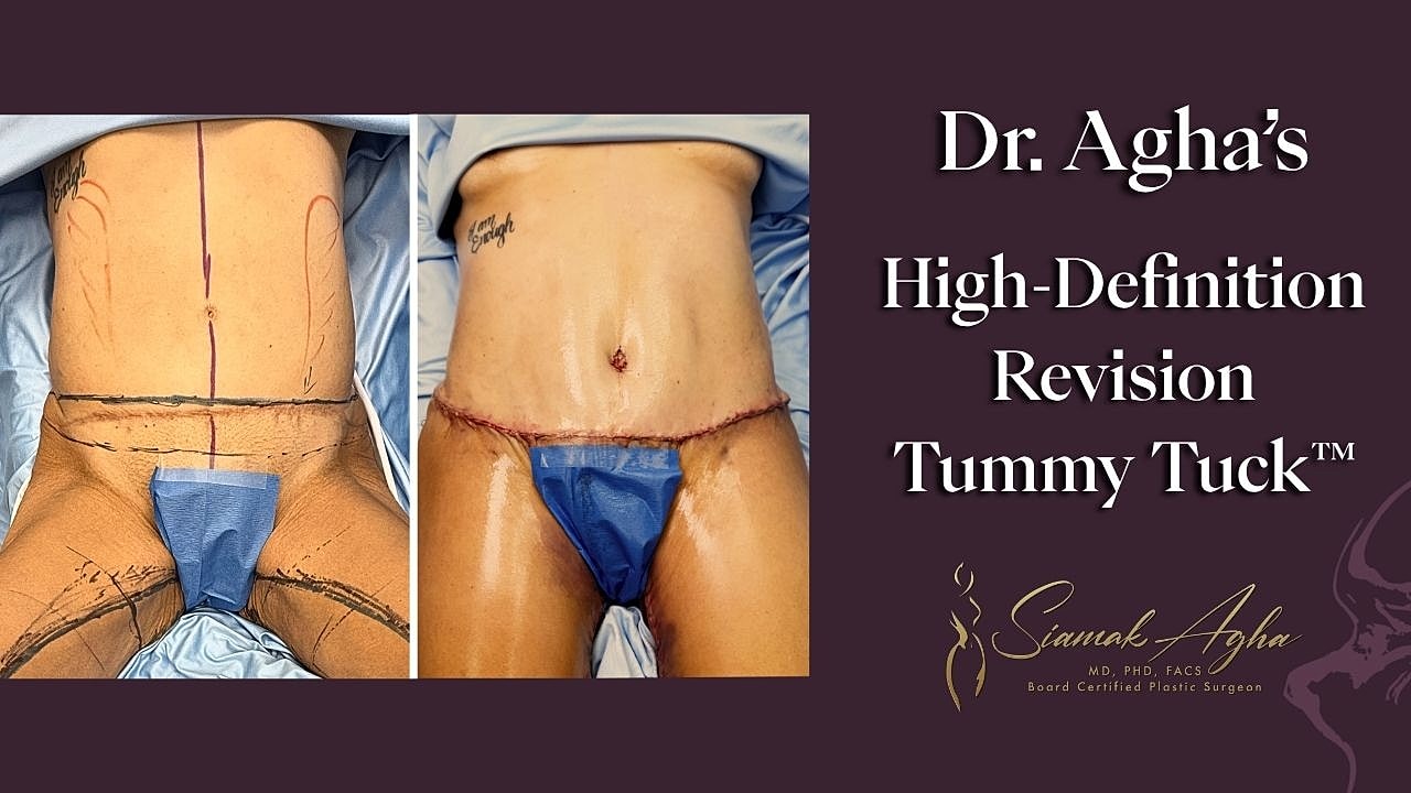 Tummy tuck revision surgery.