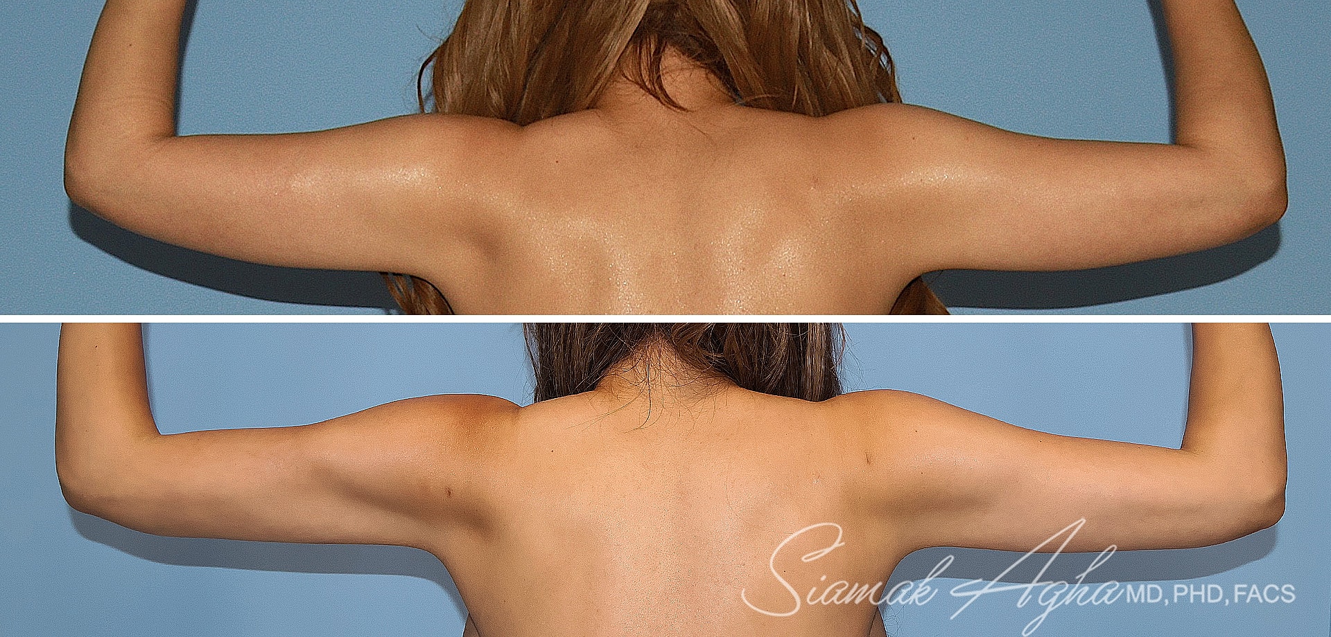 Before and after arm liposuction patient back view