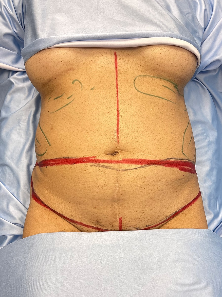 Surgical markings on a torso for procedure planning.