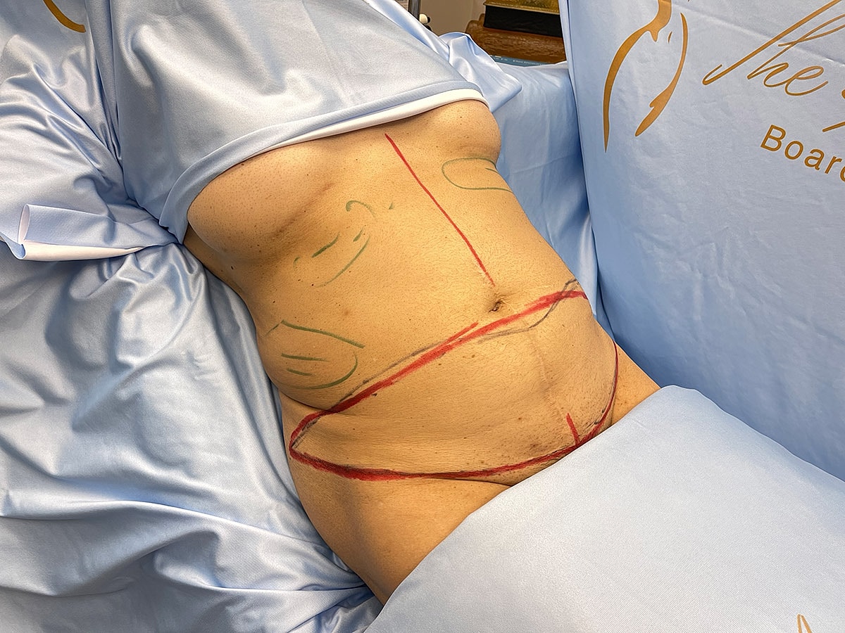 Surgical markings on a patient's abdomen.