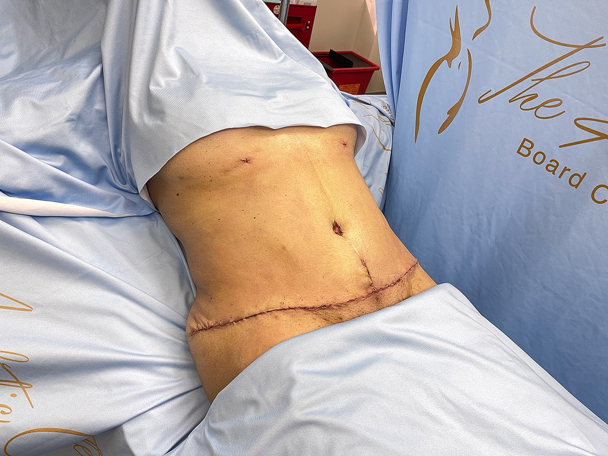 Post-surgery abdomen with visible stitches.