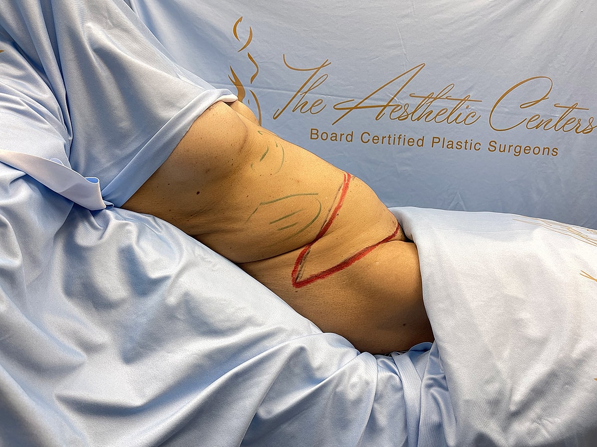 Patient preparation for cosmetic surgery consultation session.