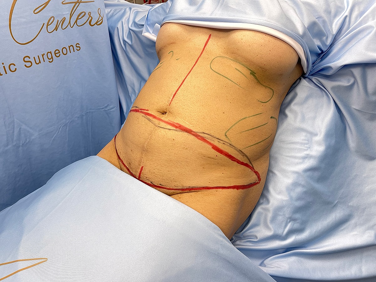 Marked abdomen for cosmetic surgery preparation.