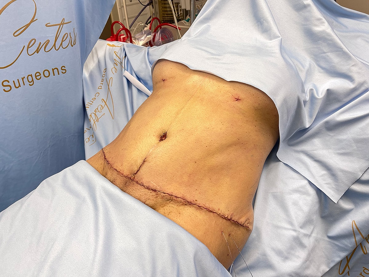 Surgical site with visible stitches post-operation.