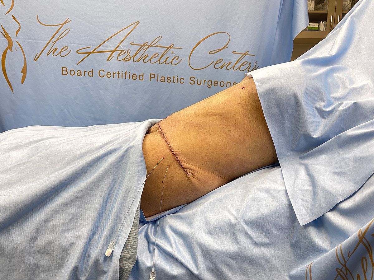 Surgical site with stitches on a patient's abdomen.