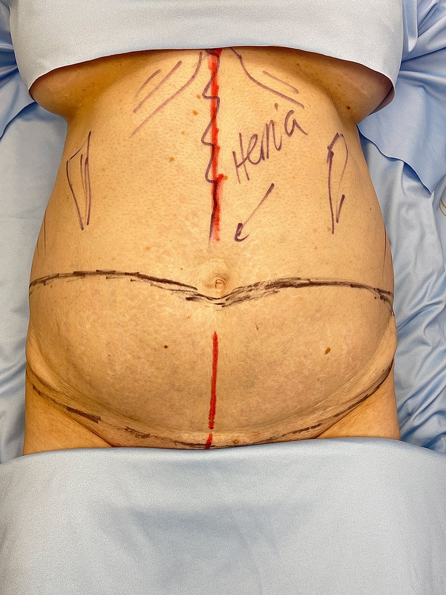 Marked abdomen indicating hernia surgery preparation.