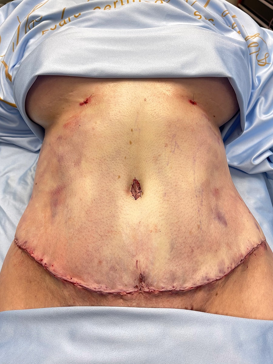 Post-surgical abdomen with sutures and bruising.
