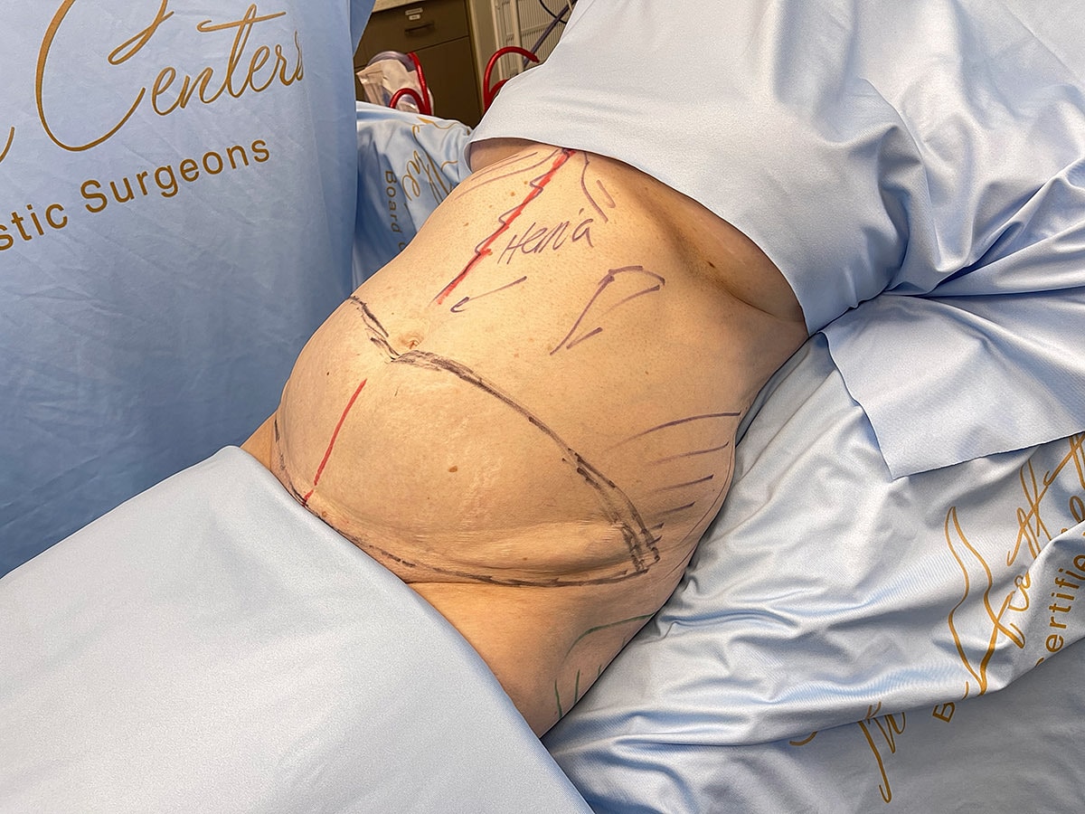 Surgical markings on patient prior to procedure.