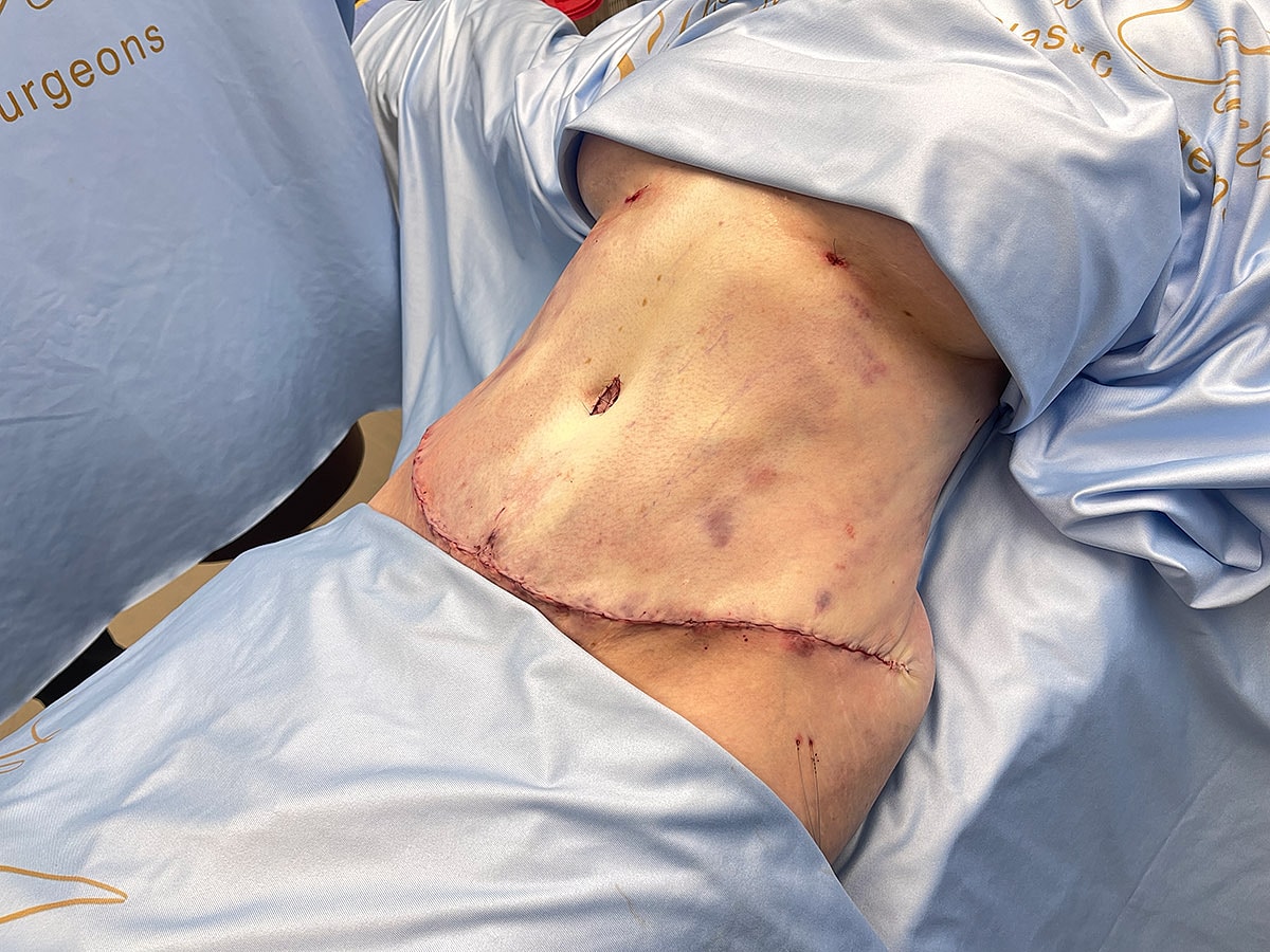 Surgical incision on the abdomen after procedure.