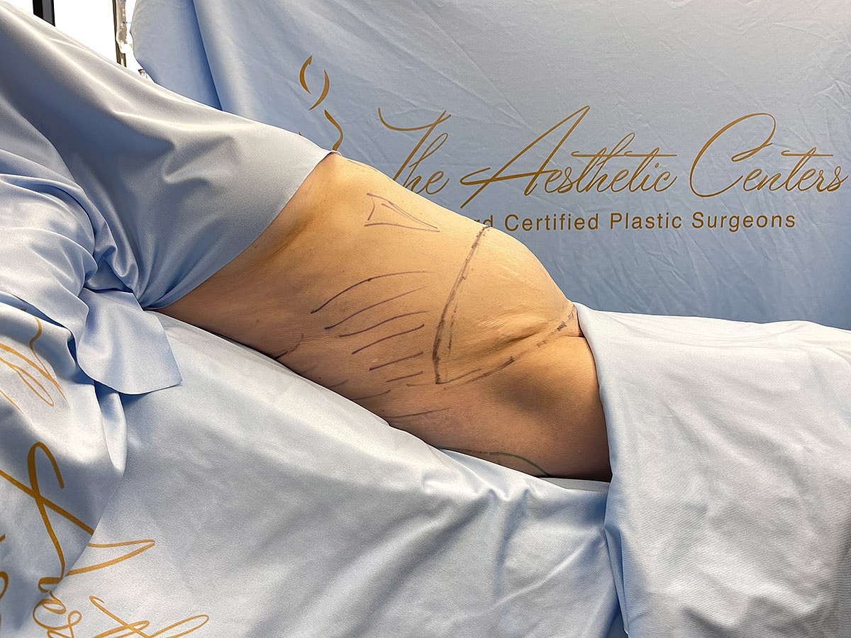 Surgical markings on patient’s side before procedure.