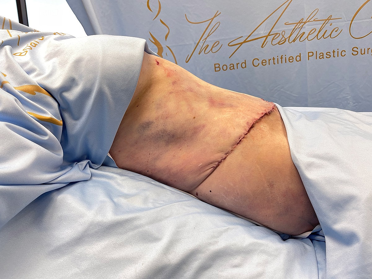 Surgical scar on patient’s side, post-procedure view.