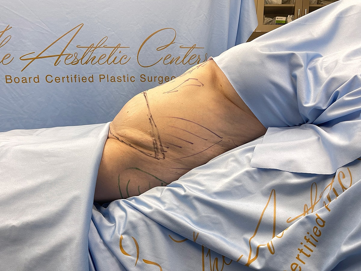 Patient preparation for plastic surgery procedure shown.