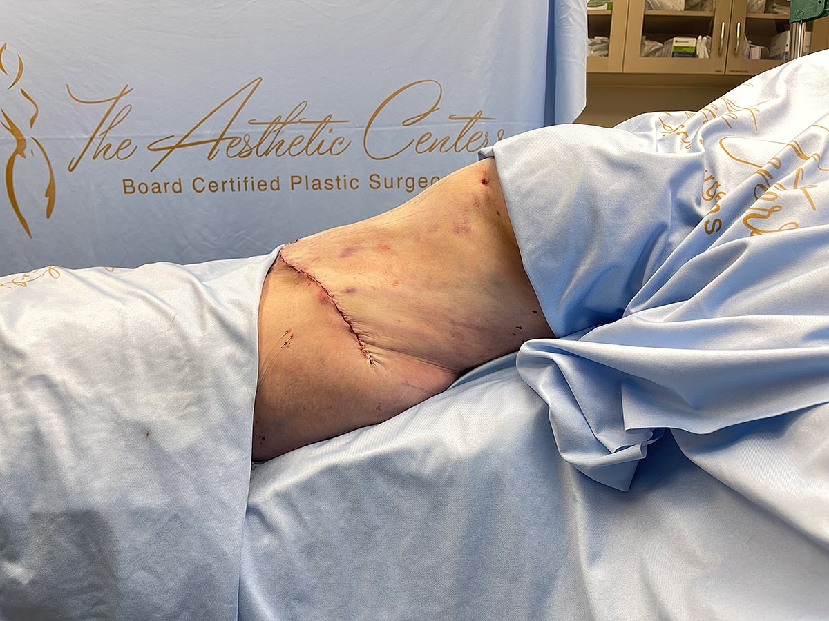 Surgical incision on patient's side under blue drape.