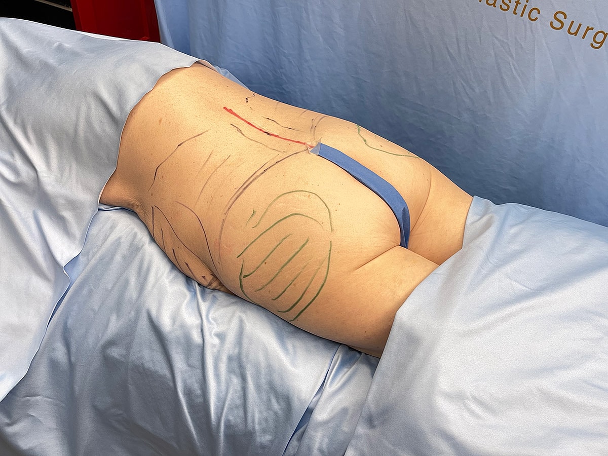 Patient prepared for body contouring surgery procedure.