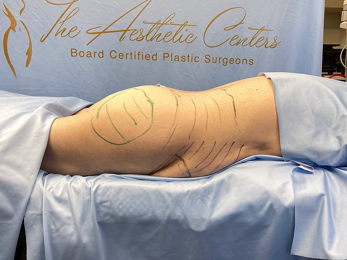 Patient preparation for cosmetic surgery procedure.