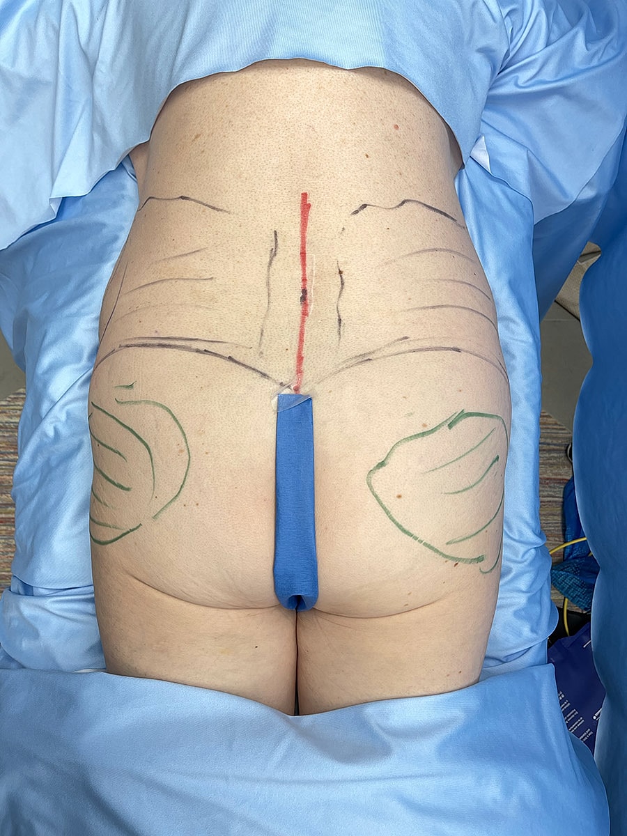 Medical markings on a patient's lower back.