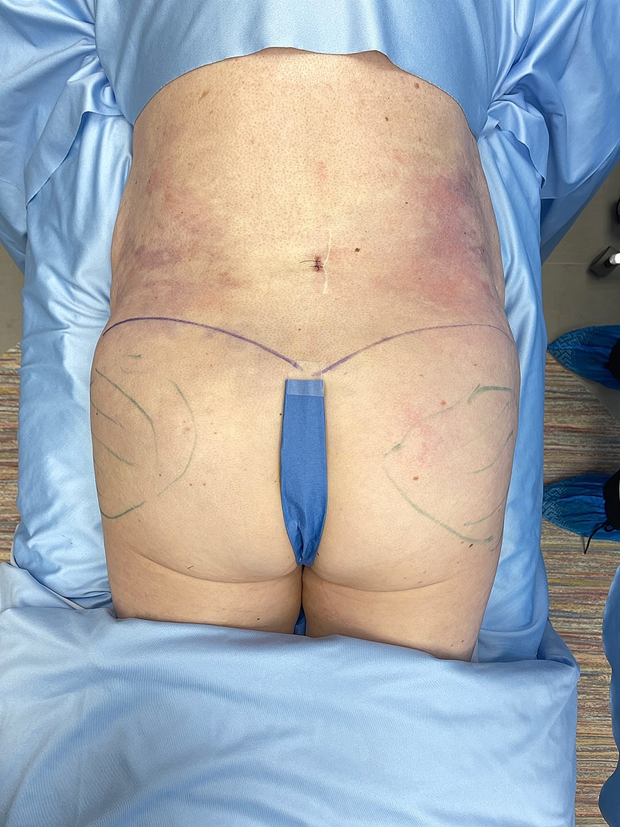 Patient preparing for surgical procedure, marked area.