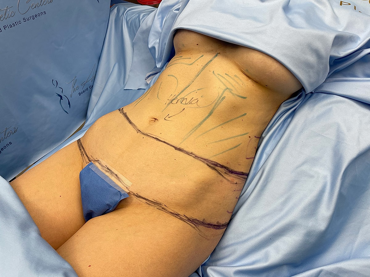 Surgical markings on abdomen before procedure.