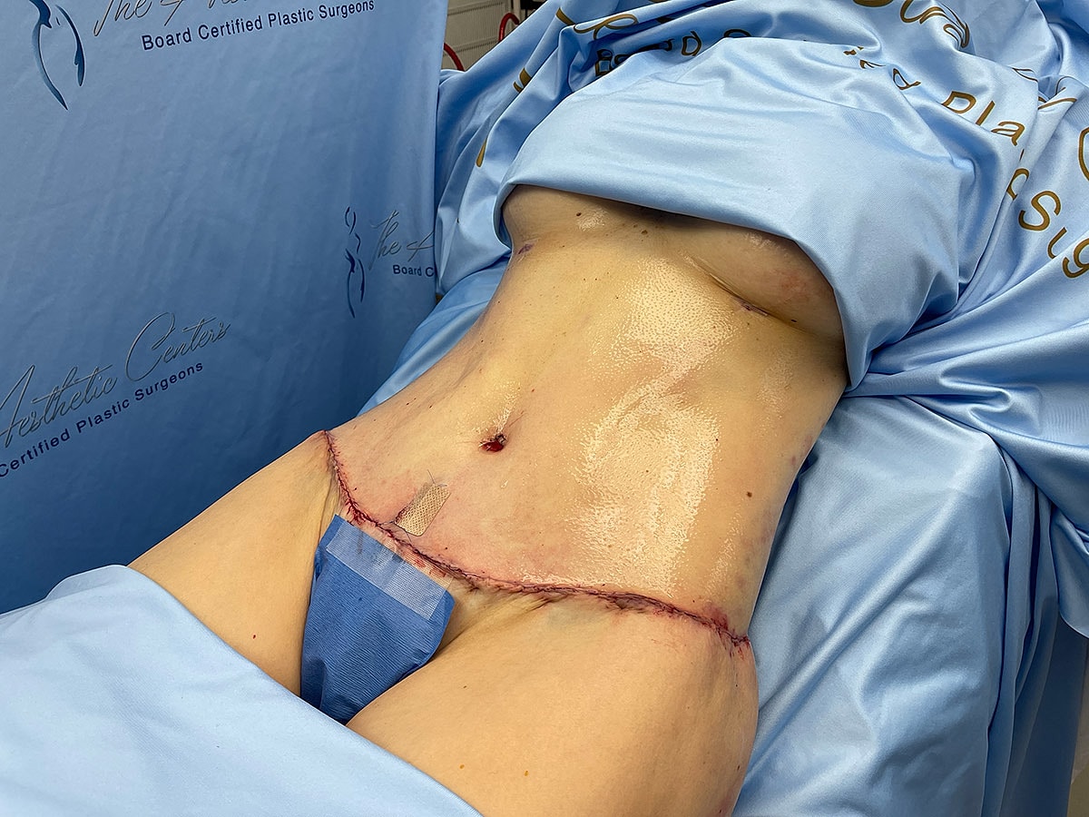 Surgical abdomen with stitches and bandages visible.