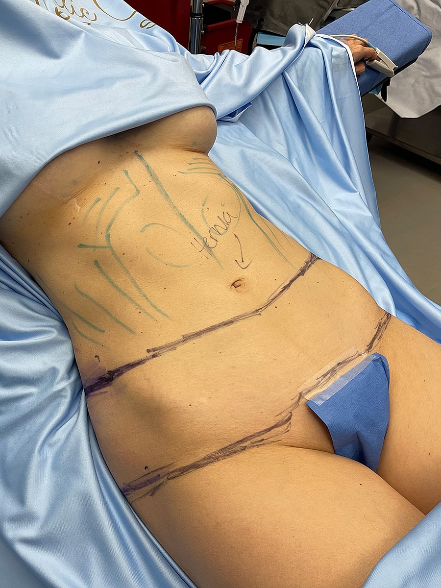 Labeled abdomen preparation for surgical procedure.