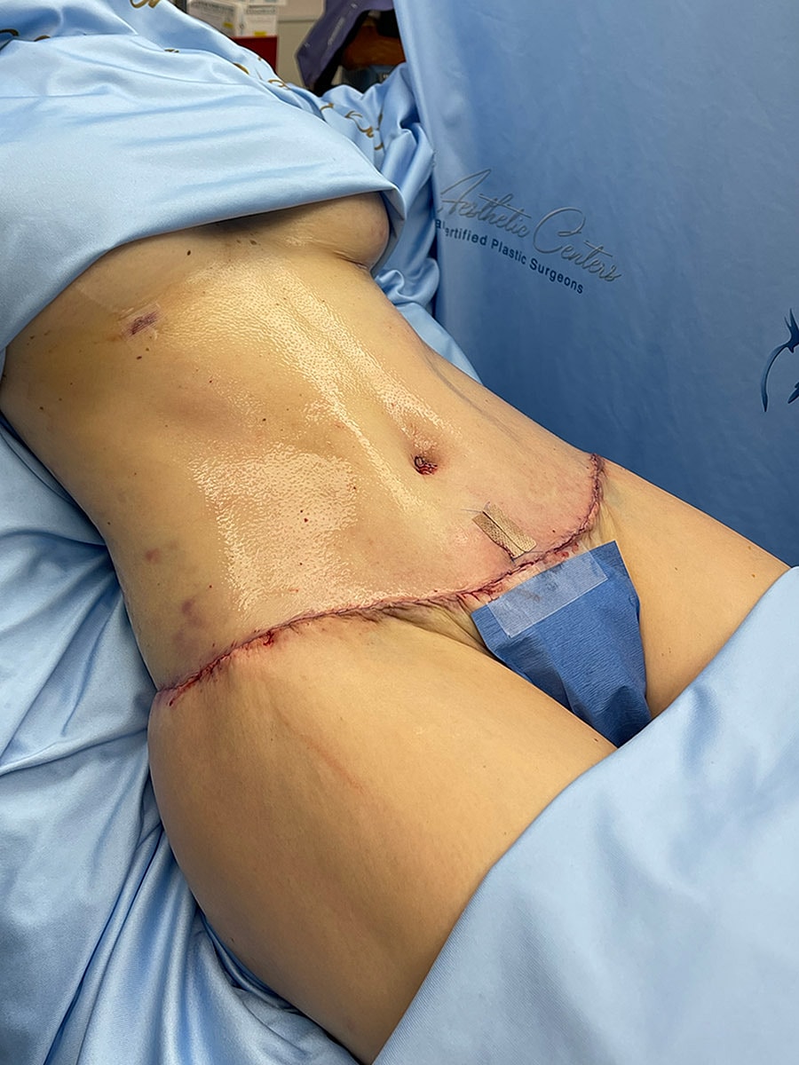 Surgical procedure on abdomen with visible stitches.