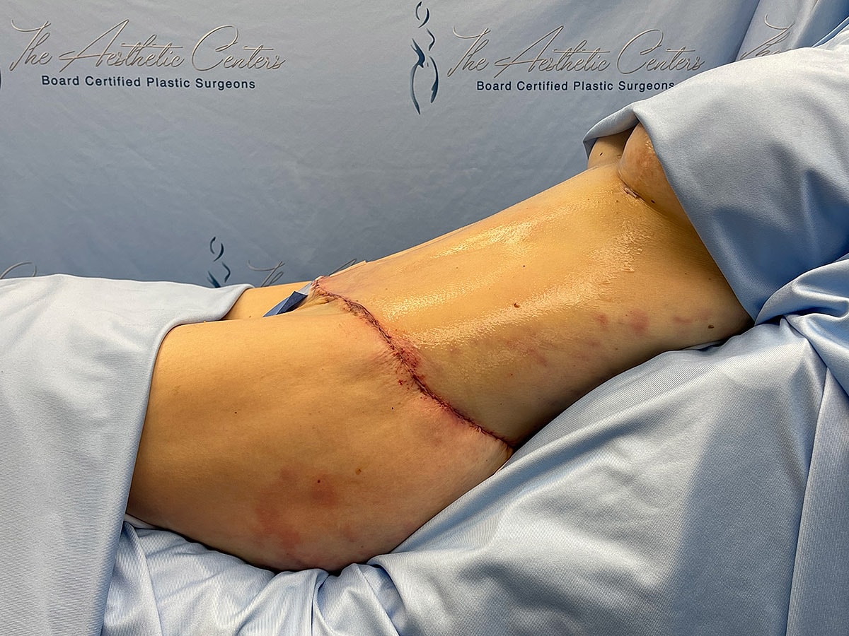 Post-surgery recovery showing incision on abdomen.