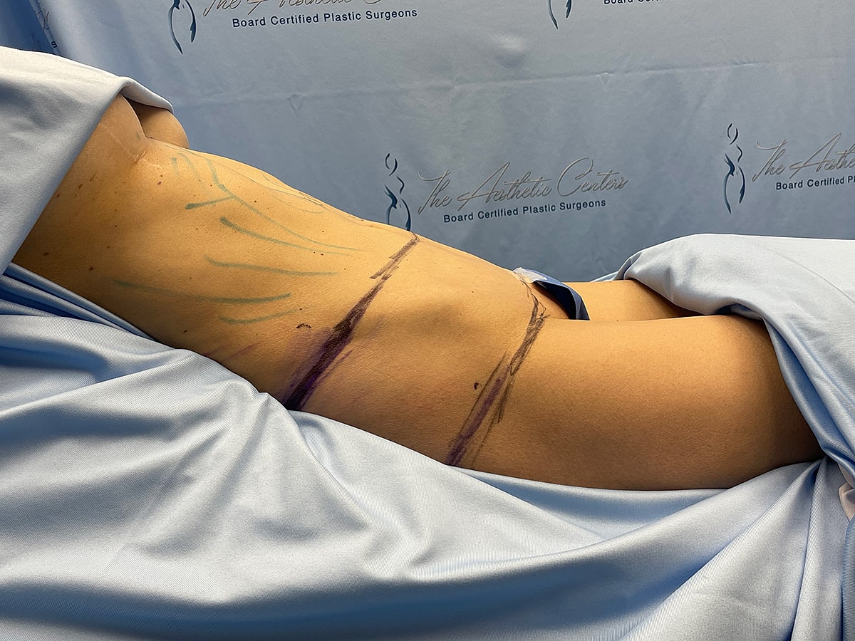 Patient preparation for a cosmetic procedure.