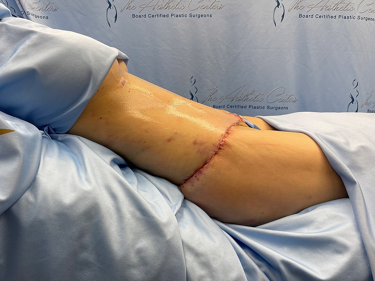 Surgical site on a patient's abdomen.