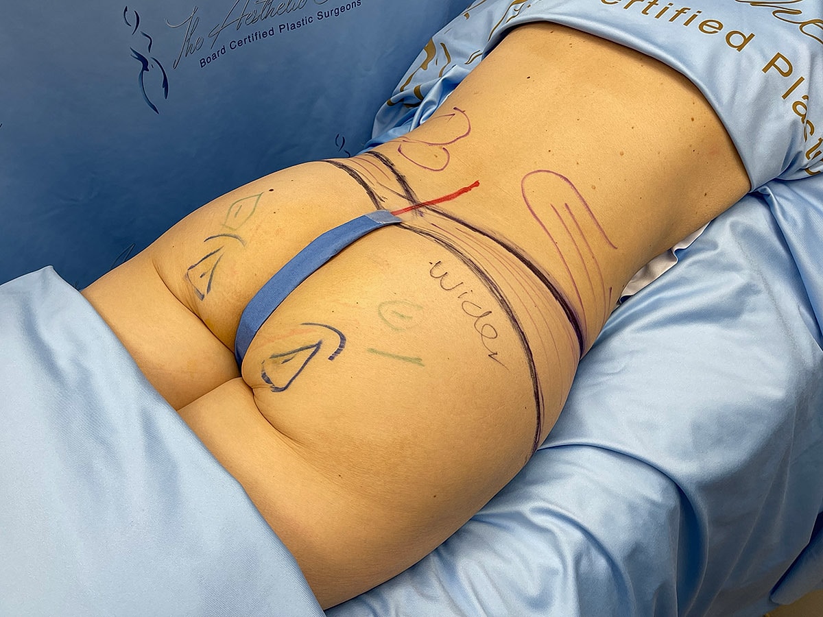 Patient preparation for cosmetic procedure markings.