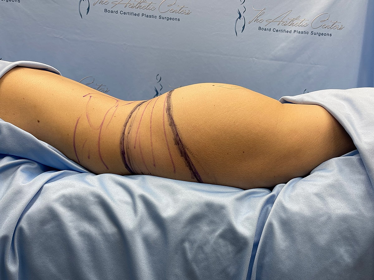 Body contouring marks on patient for surgery.
