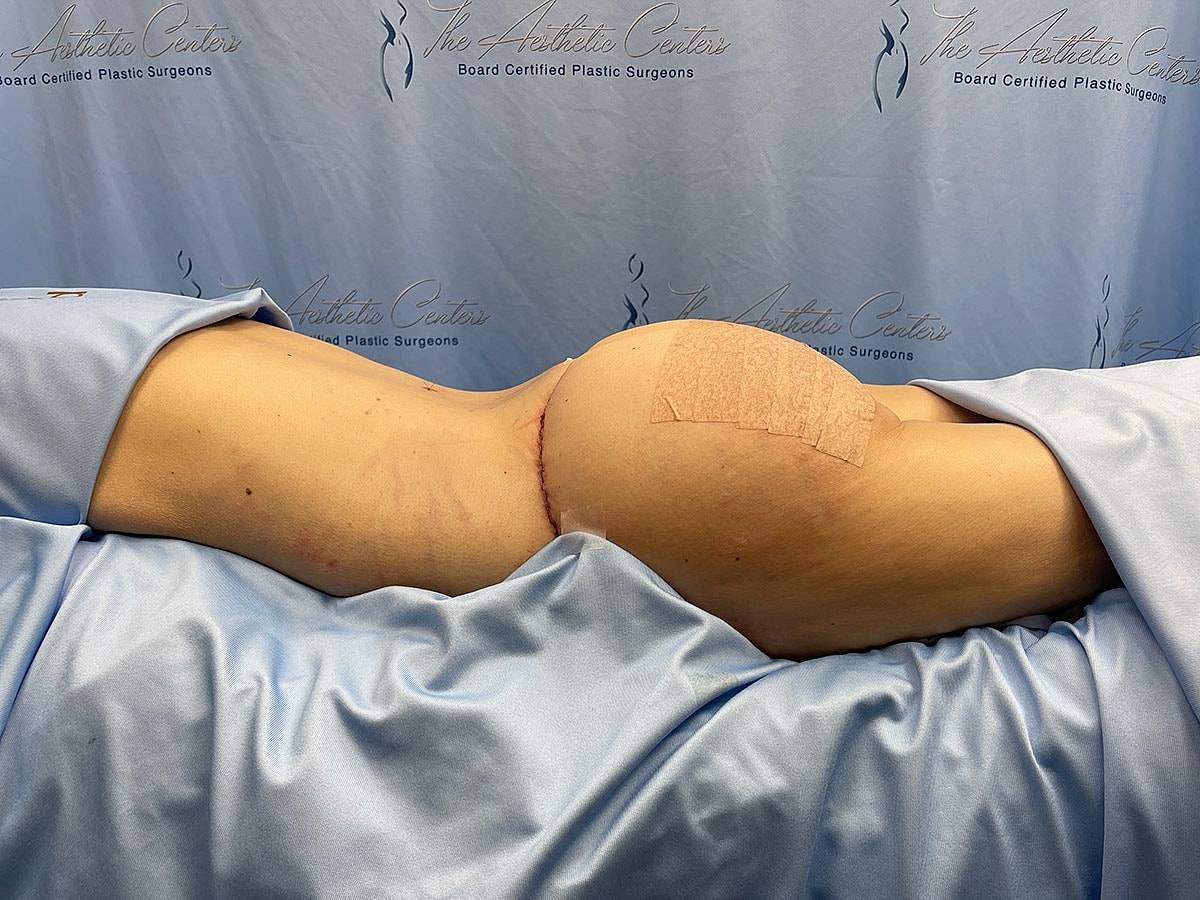 Post-surgery body with healing stitches and bandage.