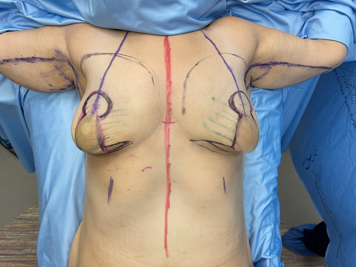 Surgical markings on a patient’s torso.