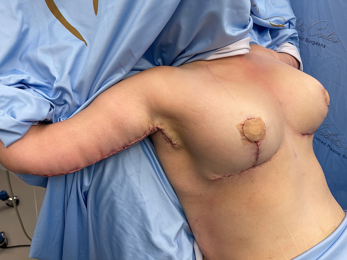 Post-surgery recovery with visible sutures and dressings.