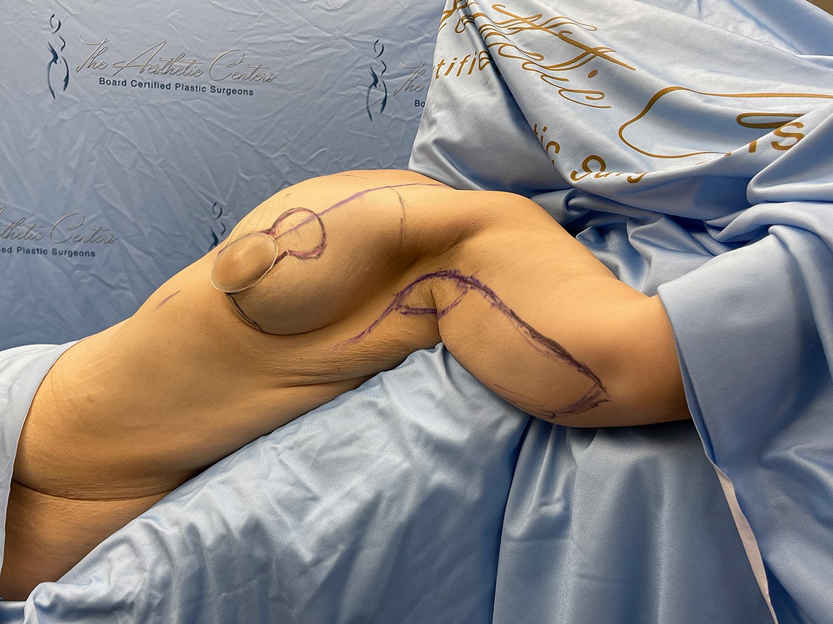 Patient with markings for plastic surgery procedure.