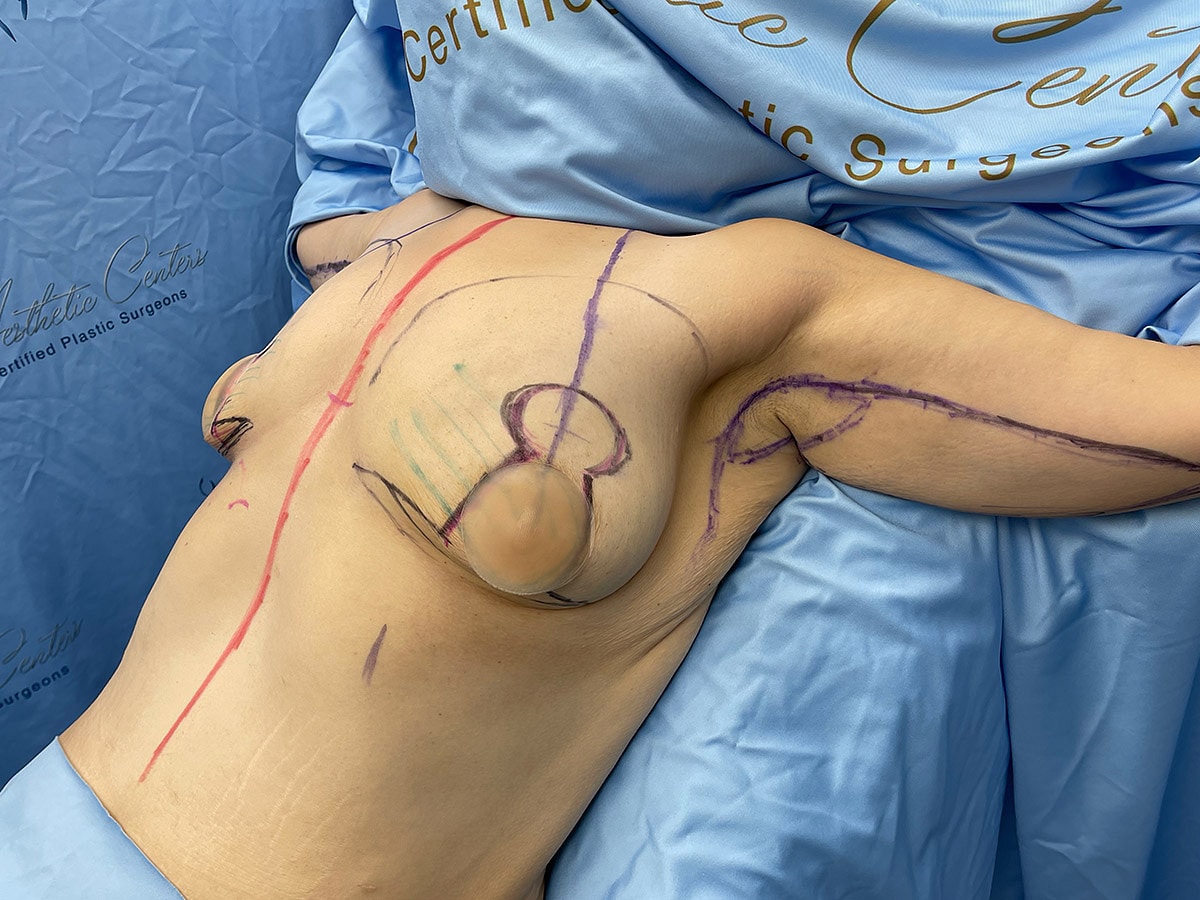 Pre-surgery markings on the torso.