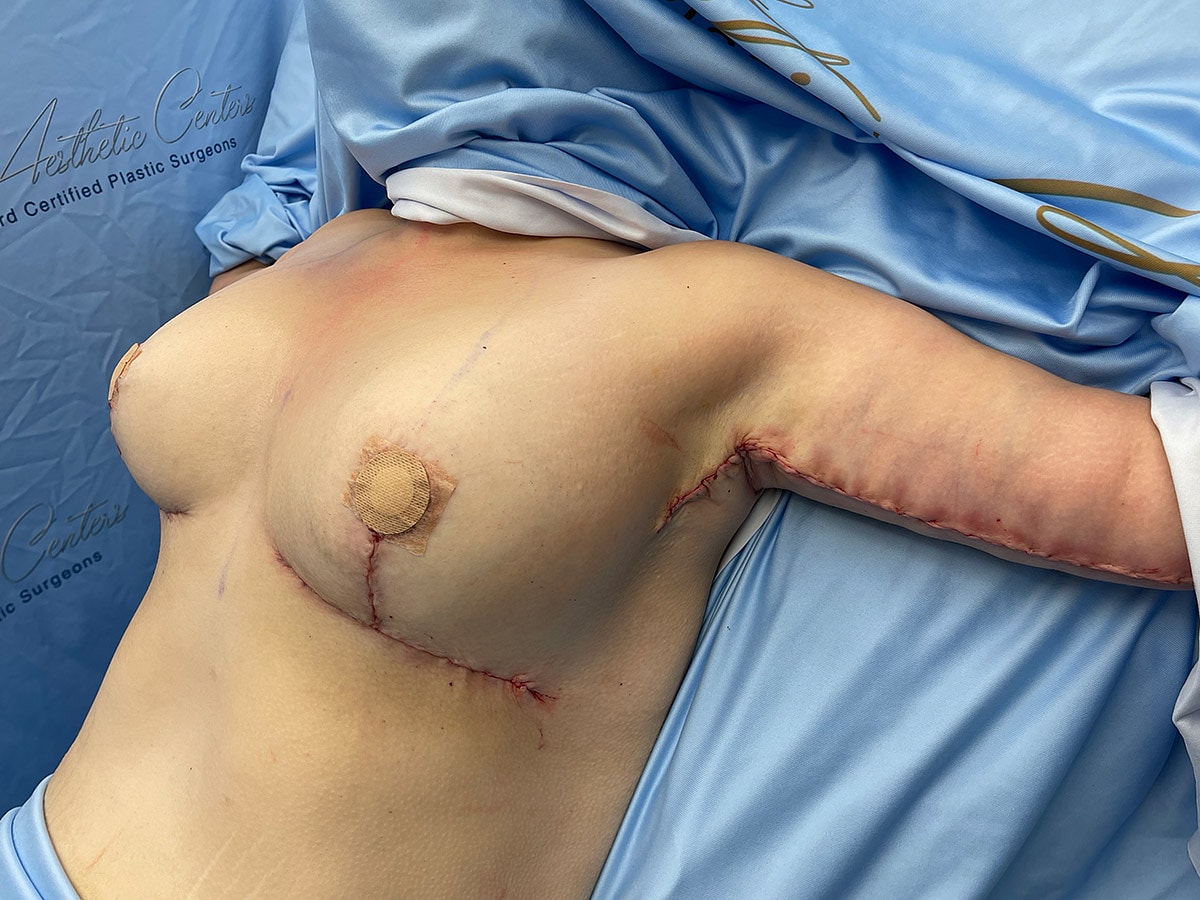 Post-surgery view of chest and arm area.