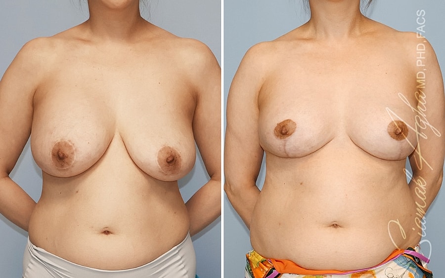 Before and after breast augmentation results.