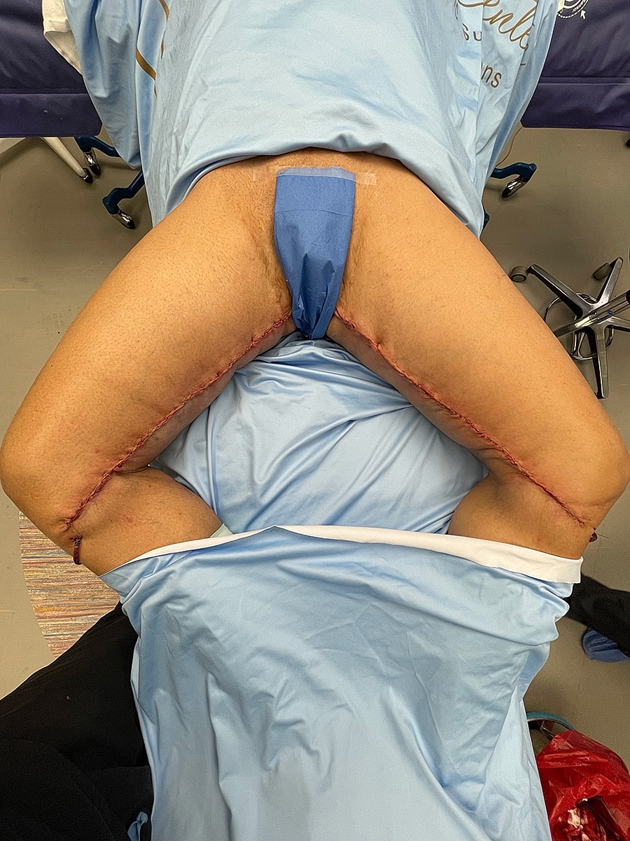 Post-surgery patient with visible incision lines.