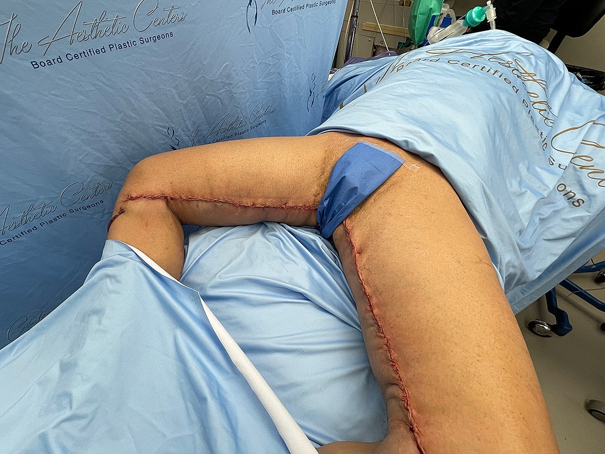 Surgical wound on patient’s thigh after procedure