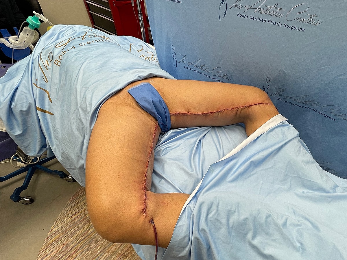 Post-surgery leg with visible stitches and dressings.