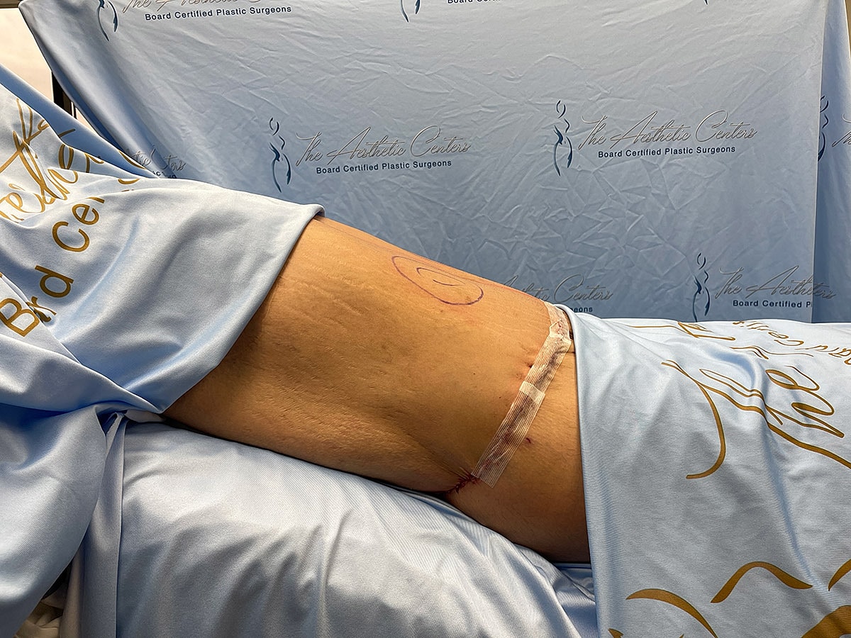 Patient in surgical gown at aesthetic clinic.